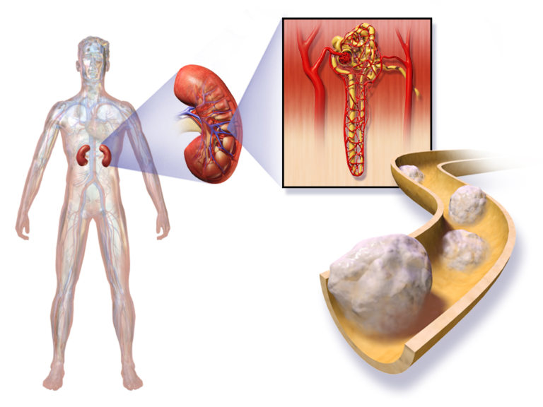 Kidney Cancer